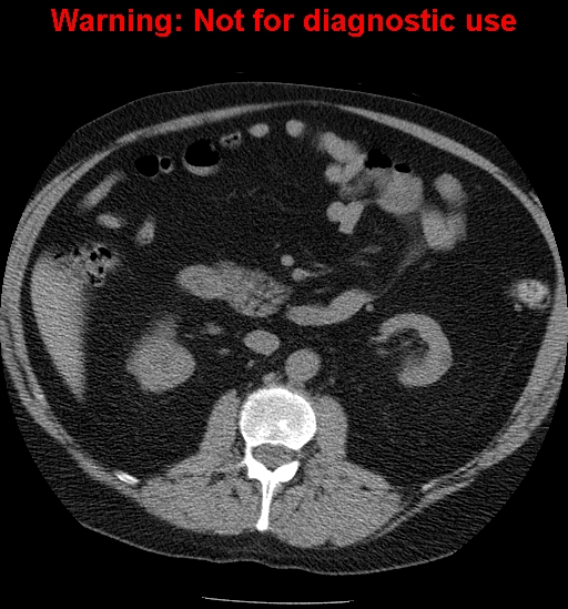 File:Bosniak renal cyst - type IV (Radiopaedia 23402-23466 Axial non-contrast 12).jpg