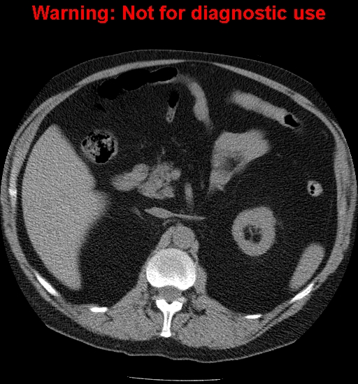 File:Bosniak renal cyst - type IV (Radiopaedia 23402-23466 Axial non-contrast 8).jpg