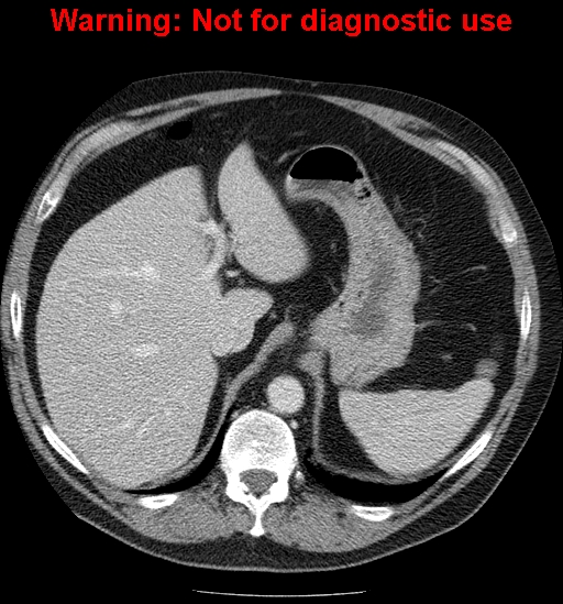 File:Bosniak renal cyst - type IV (Radiopaedia 23402-23466 D 13).jpg