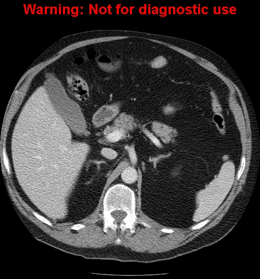 File:Bosniak renal cyst - type IV (Radiopaedia 23402-23466 D 21).jpg