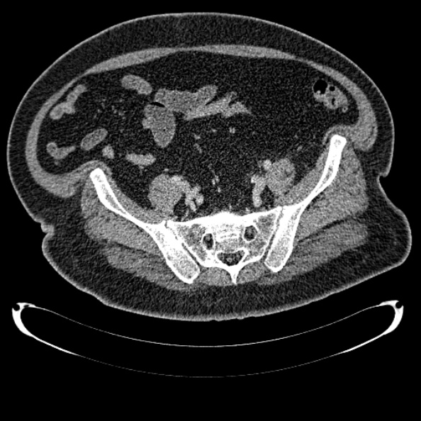 Bosniak renal cyst - type IV (Radiopaedia 24244-24518 C 303).jpg