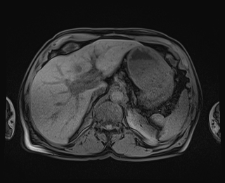 Bouveret syndrome (Radiopaedia 61017-68856 Axial T1 fat sat 23).jpg