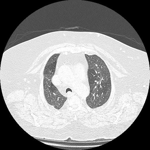 Bovine aortic arch - right internal mammary vein drains into the superior vena cava (Radiopaedia 63296-71875 Axial lung window 42).jpg