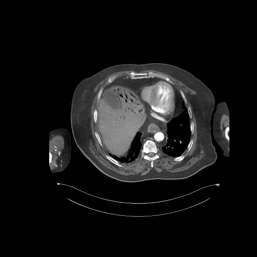 File:Bowel ischemia secondary to SMA occlusion with extensive portomesenteric venous gas (Radiopaedia 54656-60871 A 70).jpg
