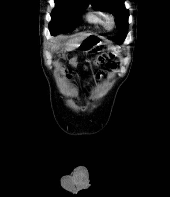 Bowel obstruction from colon carcinoma (Radiopaedia 22995-23028 C 7).jpg