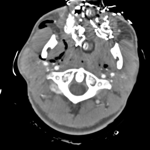 Brain contusions, internal carotid artery dissection and base of skull fracture (Radiopaedia 34089-35339 D 56).png