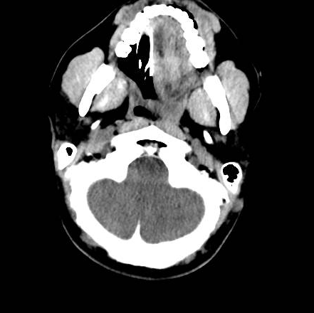 File:Brain death after motor vehicle collision (Radiopaedia 88470-105114 Axial 25).png