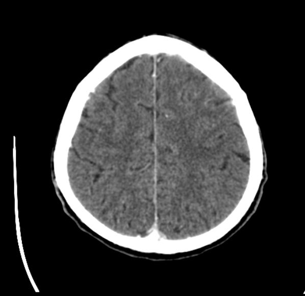 File:Brain metastases from lung cancer (Radiopaedia 24480-24781 Axial C+ delayed 48).jpg