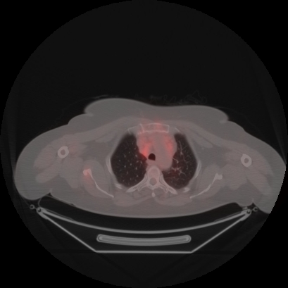 Brain metastasis (Radiopaedia 89847-106962 Axial lung window 11).jpg