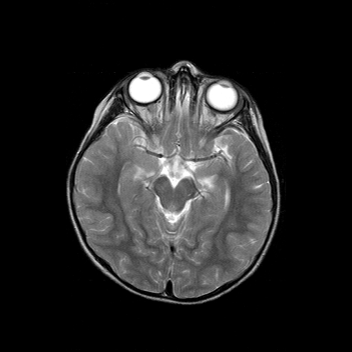 File:Brainstem ganglioglioma (Radiopaedia 10763-11224 Axial T2 12).jpg