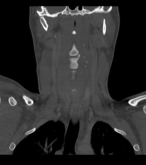 Branchial cleft cyst (Radiopaedia 31167-31875 Coronal bone window 35).jpg