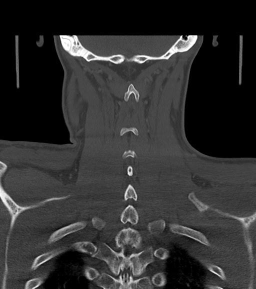 File:Branchial cleft cyst (Radiopaedia 31167-31875 Coronal bone window 51).jpg