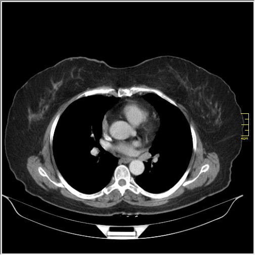 Breast cancer on thorax CT (Radiopaedia 60571-68275 A 54).JPG