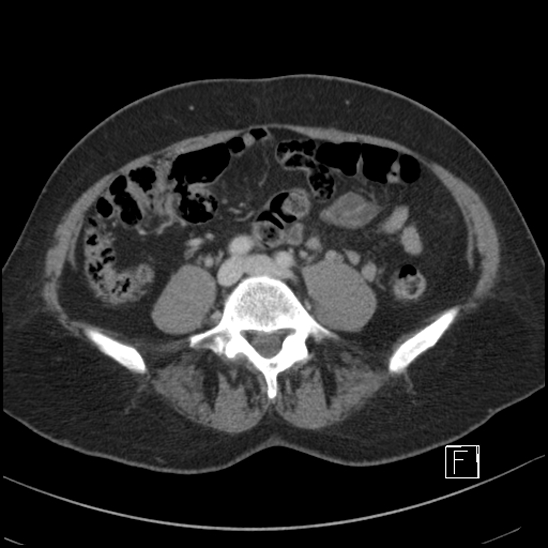 File:Breast metastases from renal cell cancer (Radiopaedia 79220-92225 C 71).jpg