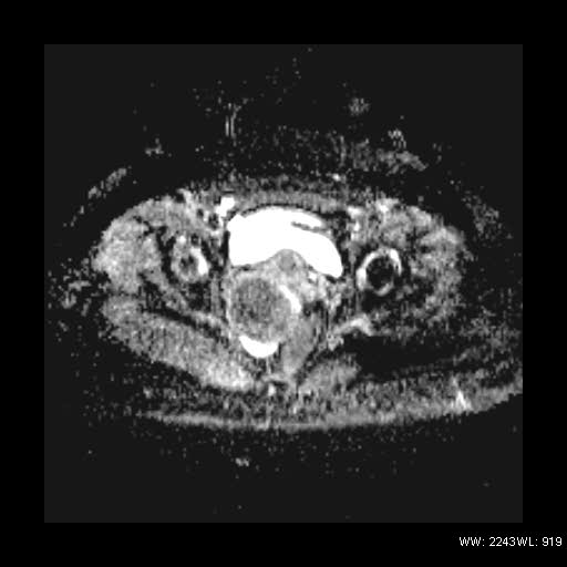 File:Broad ligament fibroid (Radiopaedia 49135-54241 Axial ADC 21).jpg