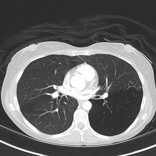File:Bronchial atresia (Radiopaedia 73677-84470 Axial lung window 32).jpg