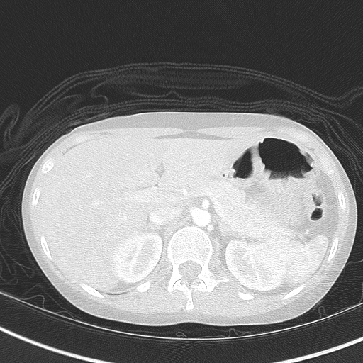 File:Bronchial atresia (Radiopaedia 73677-84470 Axial lung window 58).jpg