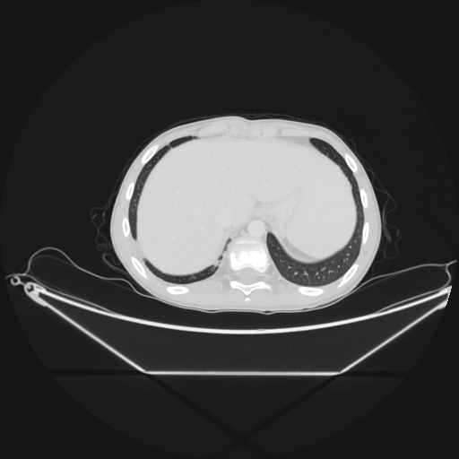 Bronchial carcinoid tumor (Radiopaedia 57187-64090 Axial lung window 69).jpg