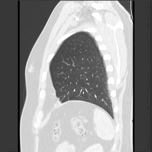 Bronchial carcinoid tumor (Radiopaedia 67377-76764 Sagittal lung window 58).jpg