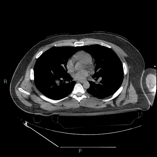 Bronchial carcinoid tumor (Radiopaedia 78272-90870 Axial non-contrast 55).jpg