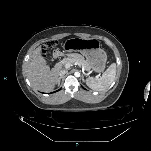 Bronchial carcinoid tumor (Radiopaedia 78272-90870 B 125).jpg