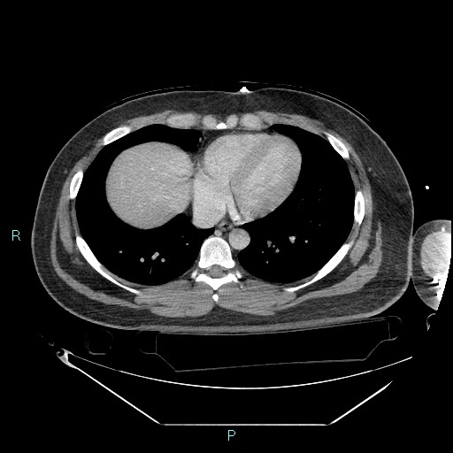 Bronchial carcinoid tumor (Radiopaedia 78272-90870 C 85).jpg
