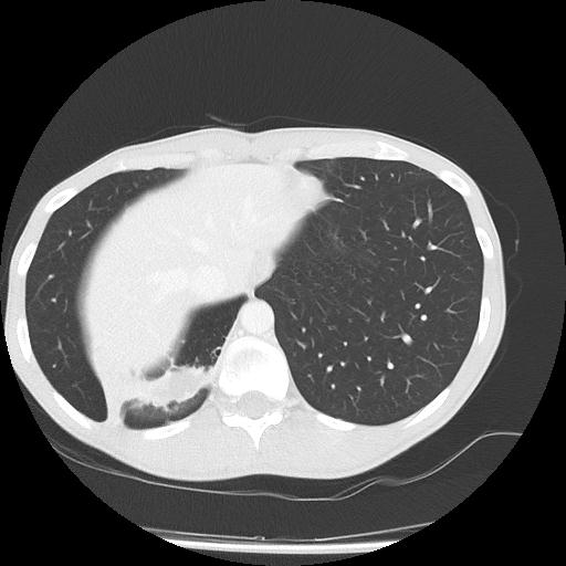 Bronchial carcinoid tumor causing right lower lobe collapse (Radiopaedia 83495-98594 Axial lung window 45).jpg