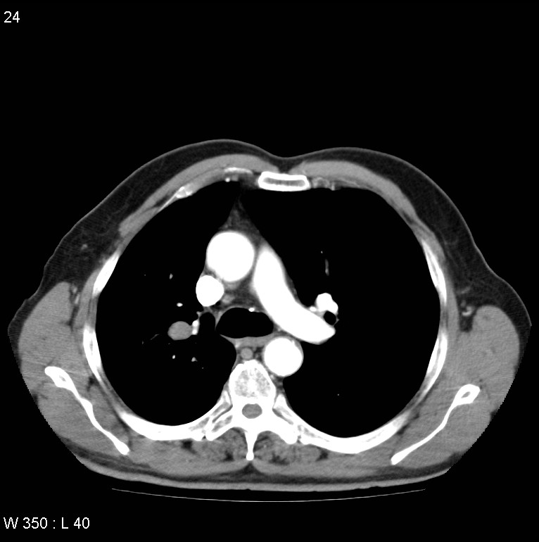 Bronchial carcinoid tumor with right lower lobe collapse (Radiopaedia 29060-29422 A 23).jpg