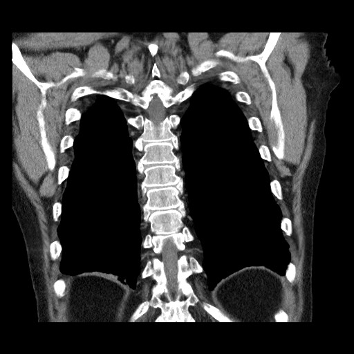 Bronchial stenosis - lung transplant (Radiopaedia 73133-83848 Coronal non-contrast 52).jpg