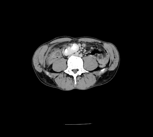 File:Bronchiectasis in Crohn disease (Radiopaedia 60311-67977 B 104).jpg