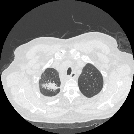 Bronchogenic carcinoma with metastatic lymphadenopathy (Radiopaedia 37671-39569 Axial lung window 10).jpg