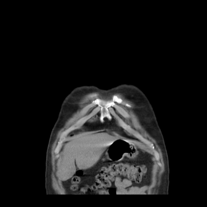 Bronchogenic carcinoma with upper lobe collapse (Radiopaedia 29297-29726 D 7).jpg