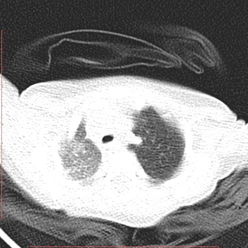 Bronchogenic cyst (Radiopaedia 78599-91409 Axial lung window 35).jpg