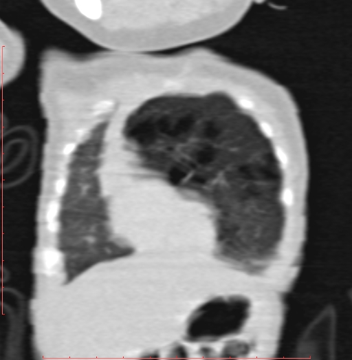 Bronchogenic cyst (Radiopaedia 78599-91409 Coronal lung window 47).jpg
