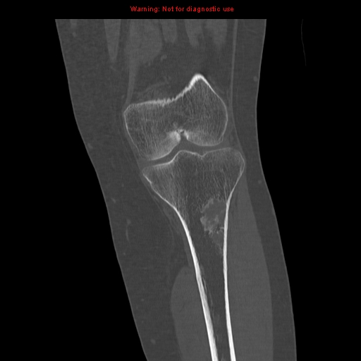 File:Brown tumors (Radiopaedia 9666-10291 Coronal bone window 16).jpg