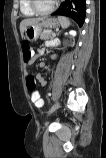 Brown tumors compressing the spinal cord (Radiopaedia 68442-77988 F 36).jpg