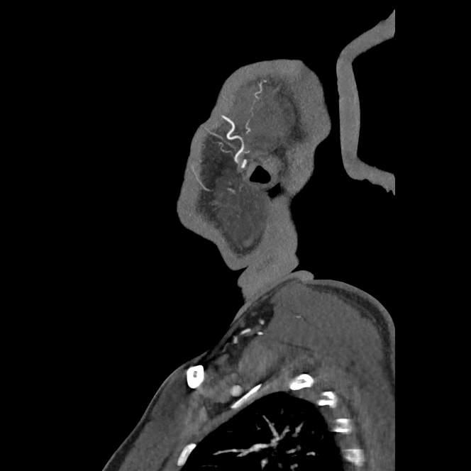 Buccal fat pad arteriovenous malformation (Radiopaedia 70936-81144 C 22).jpg