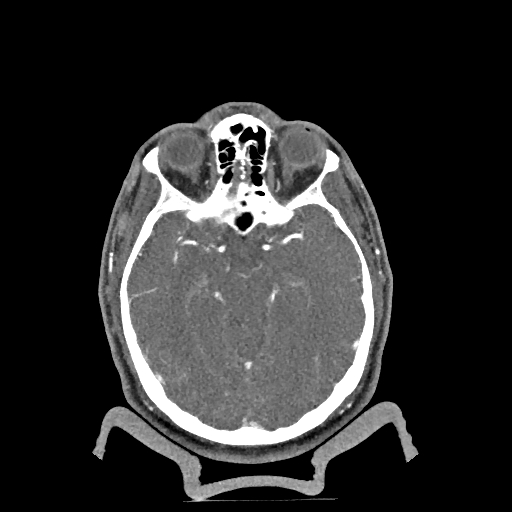 Buccal fat pad arteriovenous malformation (Radiopaedia 70936-81144 D 290).jpg