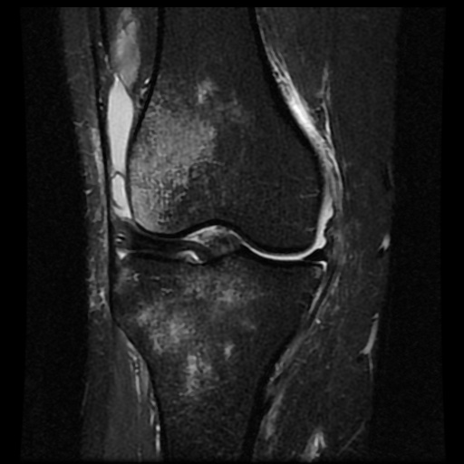 File:Bucket handle meniscus tear (Radiopaedia 56916-63751 Coronal STIR 9).jpg