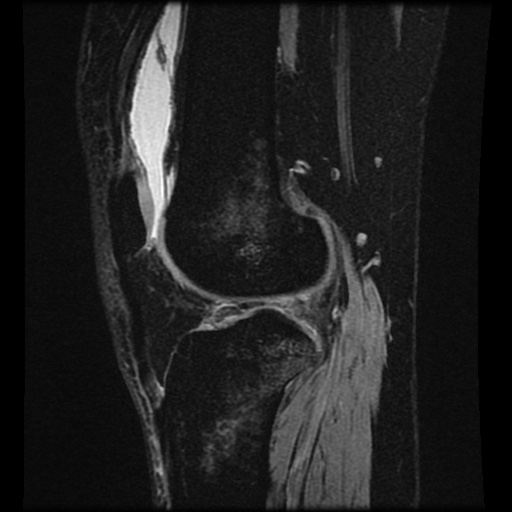 File:Bucket handle meniscus tear (Radiopaedia 56916-63751 H 30).jpg