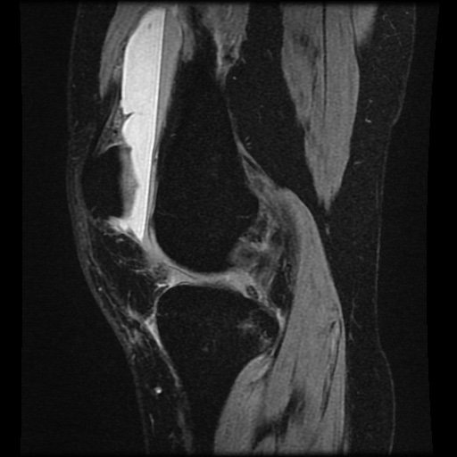 File:Bucket handle meniscus tear (Radiopaedia 56916-63751 H 51).jpg