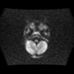 File:Burkitt lymphoma of the orbit- pre and post chemotherapy (Radiopaedia 31214-31929 Axial DWI 2).jpg