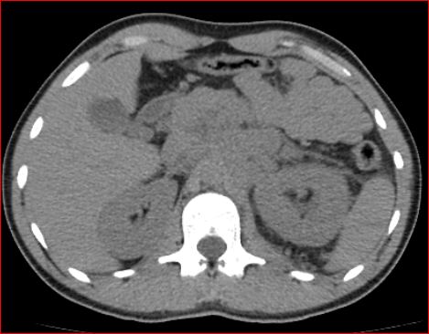 File:Burned-out testicular choriocarcinoma (Radiopaedia 32822-34040 Axial non-contrast 5).jpg