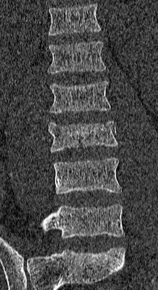 Burst fracture (Radiopaedia 53373-59357 Coronal bone window 29).jpg
