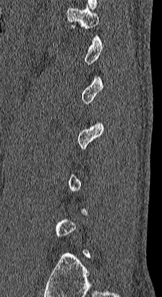File:Burst fracture (Radiopaedia 53373-59357 Sagittal bone window 9).jpg