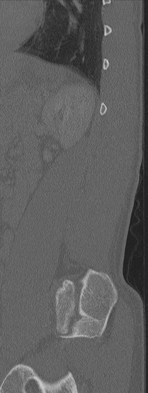 Burst fracture - T12 with conus compression (Radiopaedia 56825-63647 Sagittal bone window 12).png