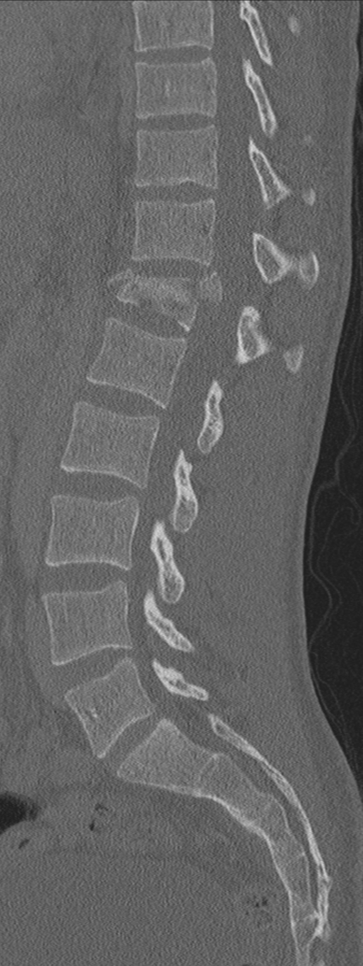 Burst fracture - T12 with conus compression (Radiopaedia 56825-63647 Sagittal bone window 38).png