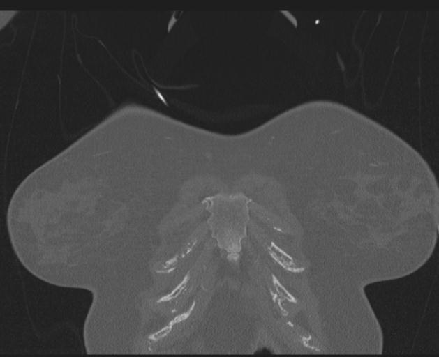 Burst fracture - thoracic spine (Radiopaedia 30238-30865 Coronal bone window 19).jpg