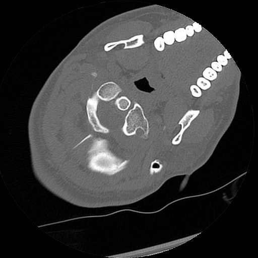 C1-C2 "subluxation" - normal cervical anatomy at maximum head rotation (Radiopaedia 42483-45607 Axial non-contrast 51).jpg