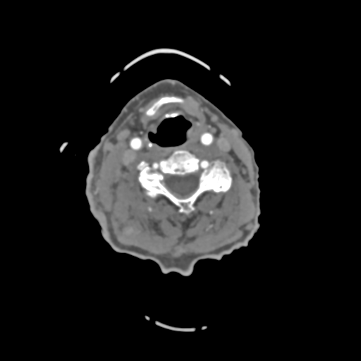 C2 fracture with vertebral artery dissection (Radiopaedia 37378-39200 A 128).png